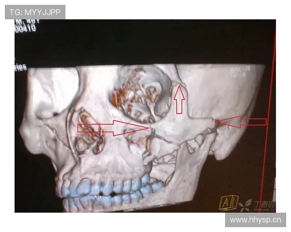 奇克因上排牙齿断裂及上颌骨折今日接受手术恢复健康